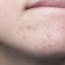 유연약국 | 올리브영 약국 여드름 피부 재생크림 레이저 후 EGF 병풀 효능