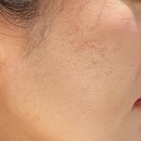 GS25노원상계역 | 상계역 피부과 한의원 얼굴 패인 흉터 제거 새살침 후기