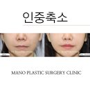 인중수술후기 및 인중수술방법에 대해 알아보기