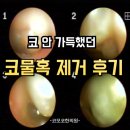 코모코한의원 | 코물혹 한의원 후기 (feat. 코모코한의원 코물혹 비수술)