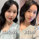 이시스더마의원 | 강남구 청담피부과 탄력리프팅레이저 리프샥 통증없고 효과좋은 후기, 전후비교 추천 1000%