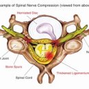 경추의 퇴행성 질환 (Cervical Degenerative Disease) 이미지