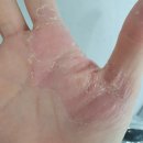 비전약국 | 발바닥한포진연고약국 가지마시고 이방법 해보세요(실제후기)