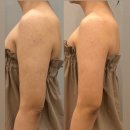 244-운정3-244 | 운정 에스테틱 운정 웨딩관리 예신관리 고연에스테틱...팔뚝 티리온 X 관리 받고 슬림해진 후기