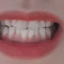 연세엘라인치과의원 네이버블로그