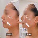 아미뷰티(AMI BEAUTY) | 처진 볼살 탄력 고민? 온다리프팅 대신 아미뷰티 온써마 10만줄로 얼굴리프팅 종결