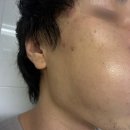 상계한의원 | 상계역 한의원 천연재생침 스피큘 미세침 4회차 리뷰