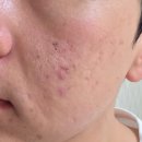 전인한의원 | 강남피부관리한의원에서 여드름패인흉터 흉터재생관리 새살침 받고온 10일 경과 찐후기