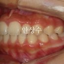 인비절라인 퍼스트 주걱턱 치료 후기 - 글로벌갤러리 등재 치과의 리뷰