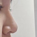 콧대높은 개 | 유행이라는 콧대 필러 하이코 받고옴…. 하이코 후기