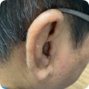 독일시그니아보청기 | 종로3가 독일보청기 귓속형보청기 착용사례, 인시오 양이착용