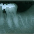 치과에서 엑스레이(방사선검사)사진을 찍는 경우는...? 이미지