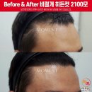 한승자원 | 모발이식가격 검색 후 꼭 보게 되는 모발이식가격후기