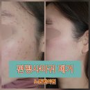 소문한의원 | 편평사마귀 거우침제거 후 재발 최소화 노하우: 노원 한의원 후기