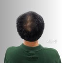 강서 정수리 두피문신, 모발이식, 탈모약 중에 고민이라면(남자후기)