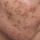 프리즘의원 | 계양구피부과에서 기미치료 패키지 받은 후기 7개월차