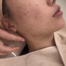 노원피부관리샵 여드름 케어 플라토닝스켈링 압출 후기