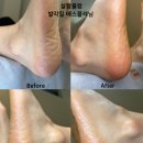 에스플래닝 | “발각질… 벗겨내니 충격적인 변화! 에스플래닝 실제 후기”