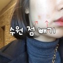 더준피부과의원 | 수원 점 빼기 광교 피부과 후기 비용 (영수증 가격 첨부)