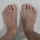 하니가 | 발가락 교정기 하니풋 사용 후기 | 잘붓는발 발가락 틀어짐 케어