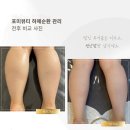 FORME:포미 | 포미뷰티 광주 서구 다이어트 마사지 리얼비교