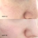 미가의료기미카페 | 부산서면피부과 포텐자 | 꼼꼼 시술 일주일 후기!