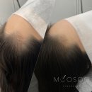 미헤어라인 이미지