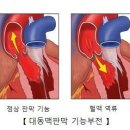 대동맥판막 기능부전 (심장 질환, 선천성 및 희귀유전성 질환) 이미지