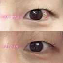 한다리길4번길L | 서울 홍대 결막모반 제거 만족후기(3달경과) l 원인 통증 비용 관리법