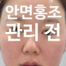 1364 | 대전 잡티관리 홍조관리 후기, 자연스러운 피부톤 변화로 환해진 요즘