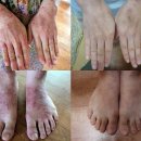 아토피(소아 아토피, 성인 아토피) 피부가려움증, 피부염의 원인 및 개선 방법-1부 이미지