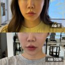 신논현 피부과 티타늄리프팅으로 탄력 톤 리프팅 효과 찐후기