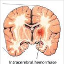 ICH (Intracerebral Hemorrhage, 뇌내출혈) 이미지