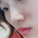 박앤리피부과의원 | 대구 상인동 박앤리 피부과 왕점제거 후기