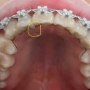 941 | [교정일기] 941일차. 평생유지장치 부착 후기, 다음주에 교정기 뗍니다!!