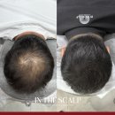 가자아카데미 | 용인두피문신 올 해 가자 후회없는 솔직 후기