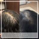 에드케어 | 중랑) 에드플러스 [부모님 탈모 걱정 해결 ‘생장술 케어’ 솔직후기]