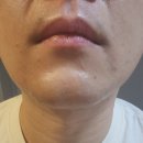 봄여름가을겨울피부과의원 | [신논현]모던스탠다드의원 제모 5회차 찐~찐~찐후기