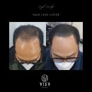 하이스칼프 이미지