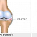 무릎 뒤쪽 오금 통증의 원인과 치료법 이미지