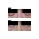 고은리프트의원 | 부산 얼굴 이물질제거 고은리프트 대만족 후기