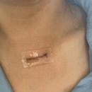 타임메디 | 갑상선암 수술 흉터관리 후기 | 메디솝 vs 메피폼 비교 (2~3주차 변화)