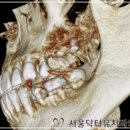 노벨치과의원 | 미금역임플란트, 유명한 브랜드 찾는다면? <치과의사 작성>