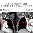 상대정맥 증후군 (SVC syndrome)의 방사선치료 이미지