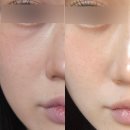 진아름다운피부과의원 | 눈밑다크써클 트라이덤 + 엘라비에리투오 후기 통증 붓기 다운타임 여의도 피부과