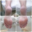 레푸스 수락산역점 | [노원,도봉 발각질] 레푸스 수락산역점- ✨발각질 스케일링 솔직 후기 ✨