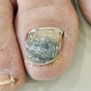 화성디에스병원 | 화성시청역 내성 발톱무좀 병원 케어 후기