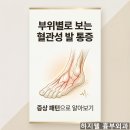 하지웰심장혈관흉부외과의원 | 족저근막염 치료해도 그대로? 발바닥·발가락 통증, 혈관을 의심해야 하는 이유