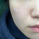 노벨약국 | 편평사마귀 신촌 노벨의원 피부과, 아가파의원 미아점 두곳 비교 방문 후기