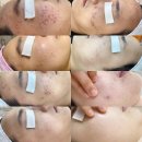 광안리피부관리 남천동에스테틱 고아진에스테틱
